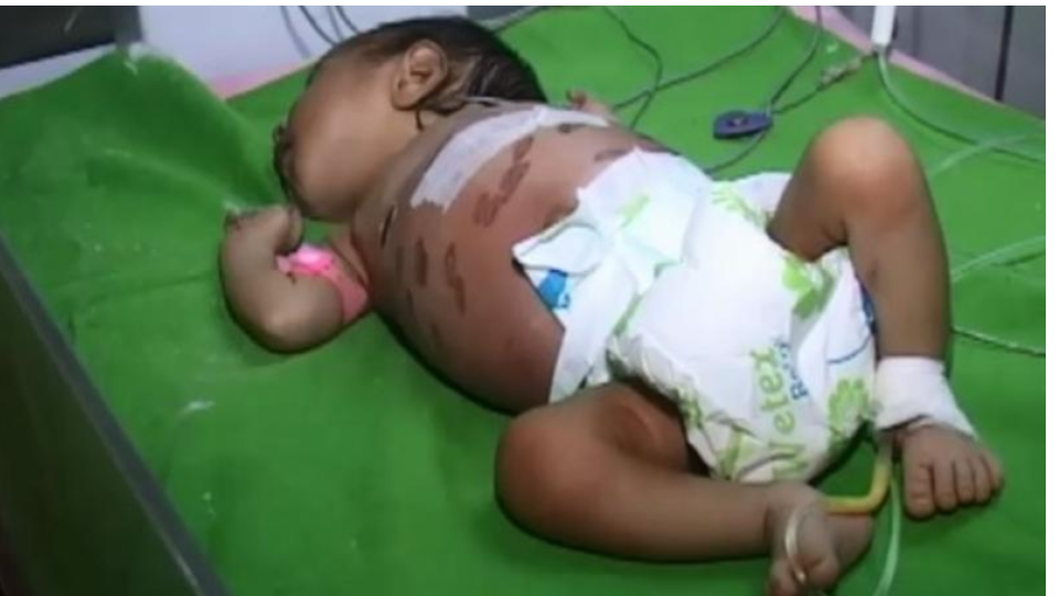 onemontholdbabybrandedwithhotironrodfor40timestocurediseaseinodisha