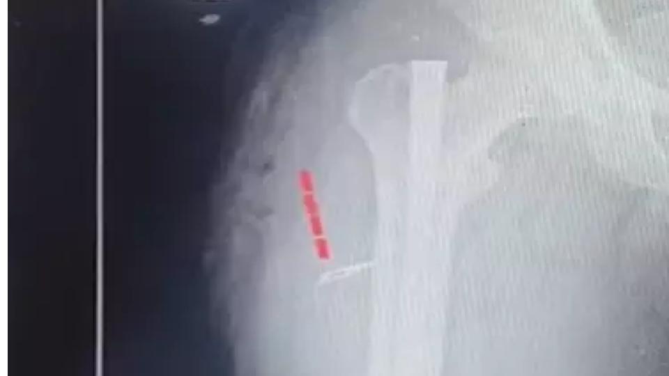 Ortho Surgeon and Nurse Suspended After Blade Left Inside Patient in Kakinada