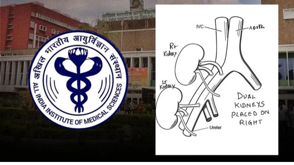 aiimsdelhiperformsfirstdualkidneytransplantof78yearoldwoman