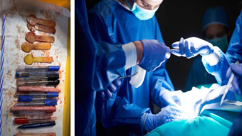 Doctors Pull Out 14 Pens, 5 Spoons and a Candle from Woman