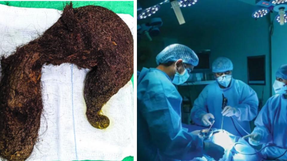 Delhi doctors remove 1.16-kg hairball 